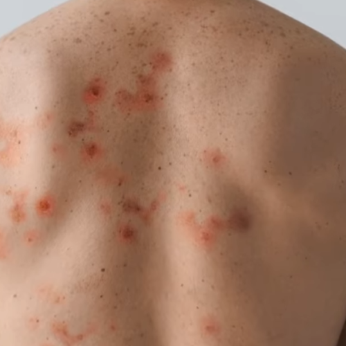 symptomes monkeypox