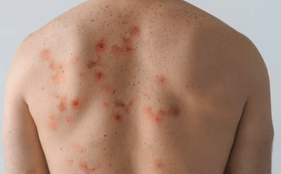 symptomes monkeypox